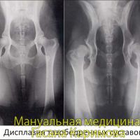 Рентген тазобедренных суставов у детей - сделать рентгенографию таза ребенку в СМ-Клиника