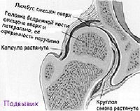 Лечение Дисплазия тазобедренного сустава и врожденный вывих бедра - Ортопедия Руслана Сергиенко