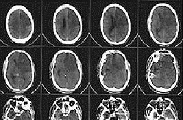 Магнитно-резонансная и компьютерная томография в диагностике ишемического инсульта
